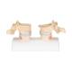 3B Scientific A95 Osteoporosis Model - 3B Smart Anatomy