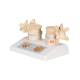 3B Scientific A95 Osteoporosis Model - 3B Smart Anatomy