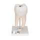 3B Scientific D10/4 Lower Twin-Root Molar Showing Cavities 2-Part - 3B Smart Anatomy