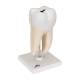 3B Scientific D10/4 Lower Twin-Root Molar Showing Cavities 2-Part - 3B Smart Anatomy