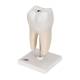 3B Scientific D10/4 Lower Twin-Root Molar Showing Cavities 2-Part - 3B Smart Anatomy