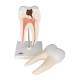 3B Scientific D10/4 Lower Twin-Root Molar Showing Cavities 2-Part - 3B Smart Anatomy