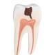 3B Scientific D10/4 Lower Twin-Root Molar Showing Cavities 2-Part - 3B Smart Anatomy