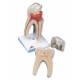 Upper Triple-Root Molar 3-Part