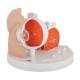 3B Scientific F17 Pathological Eye Model - 3B Smart Anatomy