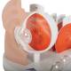3B Scientific F17 Pathological Eye Model - 3B Smart Anatomy