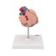 3B Scientific G04 Classic Heart Model with Left Ventricular Hypertrophy (LVH) 2-Part - 3B Smart Anatomy