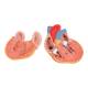 3B Scientific G04 Classic Heart Model with Left Ventricular Hypertrophy (LVH) 2-Part - 3B Smart Anatomy