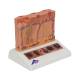 3B Scientific J15 Skin Cancer Model - Enlarged 8 Times, 3B Smart Anatomy