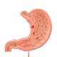 3B Scientific K17 Stomach Model with Ulcers - 3B Smart Anatomy