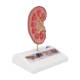 3B Scientific K29 Kidney Stone Model - 3B Smart Anatomy