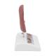 3B Scientific K29 Kidney Stone Model - 3B Smart Anatomy