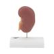 3B Scientific K29 Kidney Stone Model - 3B Smart Anatomy