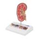 3B Scientific K29 Kidney Stone Model - 3B Smart Anatomy