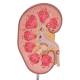 3B Scientific K29 Kidney Stone Model - 3B Smart Anatomy