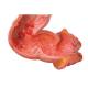Intestinal Diseases