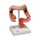 3B Scientific K55 Intestinal Diseases Model - 3B Smart Anatomy