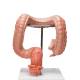 3B Scientific K55 Intestinal Diseases Model - 3B Smart Anatomy