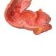 3B Scientific K55 Intestinal Diseases Model - 3B Smart Anatomy