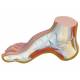 Hollow Foot Model (Pes Cavus)