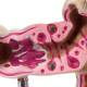 Nasco MG21850 Colon with Intestinal Pathologies Model - Angle 1 Close-up