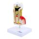 Nasco MG22727 Dental Disease Model, 10x Enlarged - Left Angle