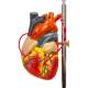 Nasco MG22747 Effects of Arterial Hypertension Pathology Model, 5-Part, Heart Close-up View