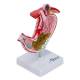 Nasco MG23162 Stomach with Gastric Ulcers Model - Right Angle
