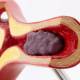 Nasco MG29729 Arteriosclerosis and Thrombosis with Artery Cross-Section Model, Close-up View