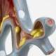 Nasco MG31098 Bronchial Tree Section Pathology Model, 10x Enlarged, Front View, Airway Damaged