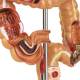 Nasco MG35589 Colon and Rectum with Intestinal Pathologies Model - Angle 2 Close-up