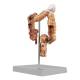 Nasco MG35589 Colon and Rectum with Intestinal Pathologies Model - Left Angle