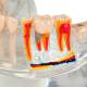 Nasco MG38398 Translucent Adult Dentition Normal and Pathology Model - Pathologies Close-Up 2