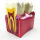 Nasco MG39442 Dental Disease Model, 6x Enlarged - Left Angle Normal