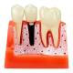 Nasco MG39444 Dental Implant Model, 8 Parts - Angle 3