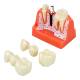 Nasco MG39444 Dental Implant Model, 8 Parts - Angle 1
