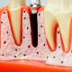 Nasco MG39444 Dental Implant Model, 8 Parts - Angle 4