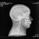 RSD RS-108TCB Head Phantom with Cadaver Bones, Transparent - Clinical Image of Head with Cervical Spine