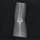 RSD Elbow Phantom (Natural Position) - Clinical Image