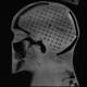 RSD RS-MMH Multi-Modality Fusion Head Phantom - Clinical Image Side View