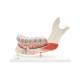 3B Scientific VE290 Advanced Half Lower Jaw with 8 Diseased Teeth 19-Part - 3B Smart Anatomy