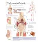 Understanding Arthritis Chart