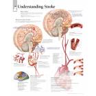 Understanding Stroke Chart