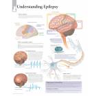 Understanding Epilepsy Chart