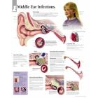 Middle Ear Infections Chart