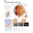 Understanding Glaucoma Chart