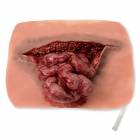 Life/form Moulage Wound - Eviscerated Intestine Simulator