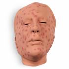 Life/form Moulage Wound - Smallpox, 2nd Day, Face Simulator