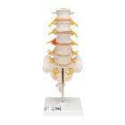 3B Scientific A76/5 Human Lumbar Spinal Column Model with Dorso-Lateral Prolapsed Intervertebral Disc - 3B Smart Anatomy