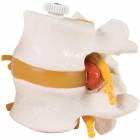 2 Lumbar Vertebrae With Prolapsed Disc Flexibly Mounted